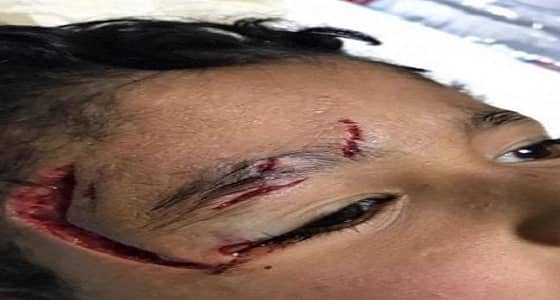 كلب ضال يهاجم طفل وينهش وجه في القريات .. " صوره "