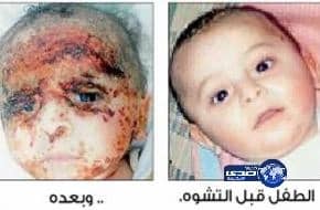 مواطن يتهم مستشفى حكومياً بالإهمال وتشويه وجه طفله