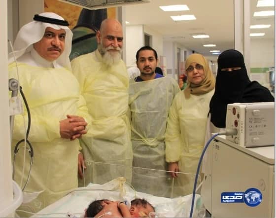 ولادة مكة يشهد أول إنجاب توأم سيامي