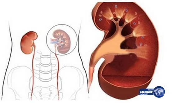 مواطن يكتشف بعد 27 عاماً أنه ولد بـ 3 كلى
