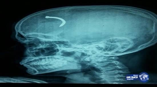 إزالة مسمار استقر في دماغ مقيم هندي