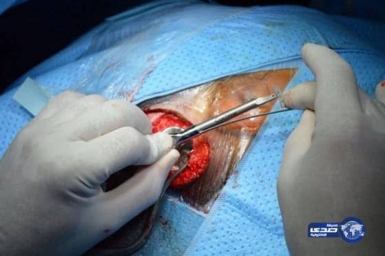 بالصور : مستشفي احد يجري اول عملية لـ زراعة السماعات العظمية "BAHA"
