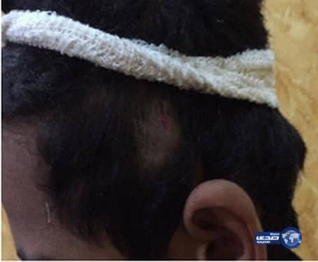 معلم يَشج رأسَ طالب بالعِقَال في محافظة البدع