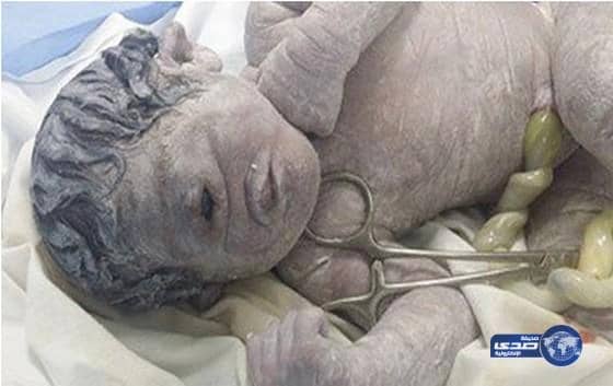 ولادة طفل بـ"عين واحدة" في منتصف الوجه في مصر