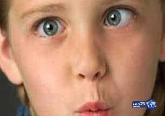 إجراء أول عملية تصحيح حول بمستشفى بيش