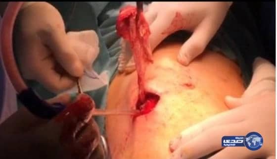 مستشفى بالمدينة يترك قطعة شاش طبي في ظهر مريضة