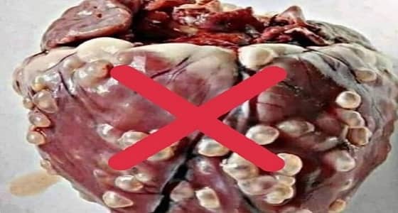 خالد النمر: صحة قلب المرأة لاتتأثر بالحزن