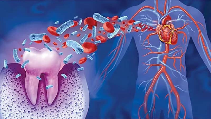 بكتيريا اللثة تزيد خطر الإصابة بأمراض القلب