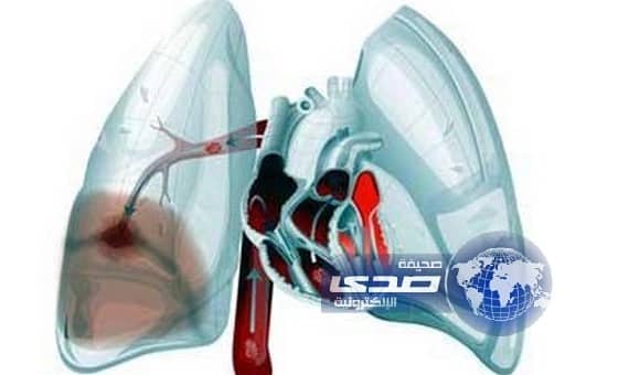 "السدة الرئوية" ثالث سبب للوفاة في العام بحلول 2020