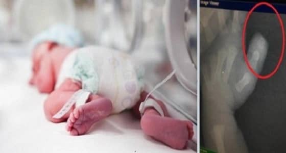 العثور على الجزء المبتور بالقمامة..أخر المستجدات بواقعة بتر إصبع رضيعة أحد رفيدة