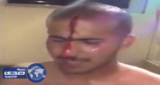 إصابة خطيرة لشاب أراد الاستعراض في حوض سباحة.. «فيديو»