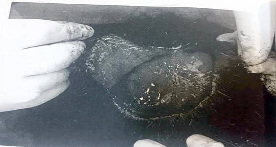 مواطنة تصاب بالصدمة بعدما سلخ الطبيب فروة رأسها خلال عملية زرع لشعرها