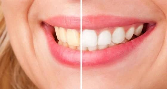 لابتسامة مشرقة.. نصائح هامة لتجنب إصفرار الأسنان