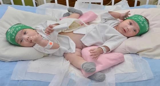 تأجيل إجراء عملية فصل التوأم السيامي " شيخة وشموخ " بسبب عارض صحي