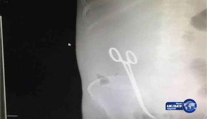 أمير حائل يوجه بالتحقيق في واقعة نسيان المقص