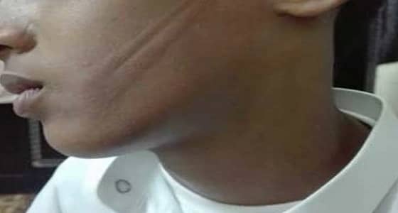 طالب يتعرض للاعتداء بـ " سلك " على وجهه من قبل معلمه