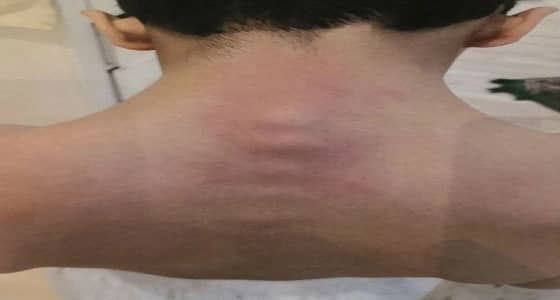 معلم يتسبب في إصابة طالب بانزلاق في الفقرات بـ " خميس مشيط "