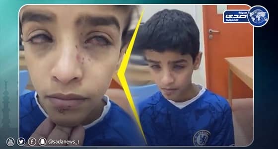 فيديو مؤثر لطفل مصاب بمرض غريب في عينه ولا يستطيع العلاج بالليث