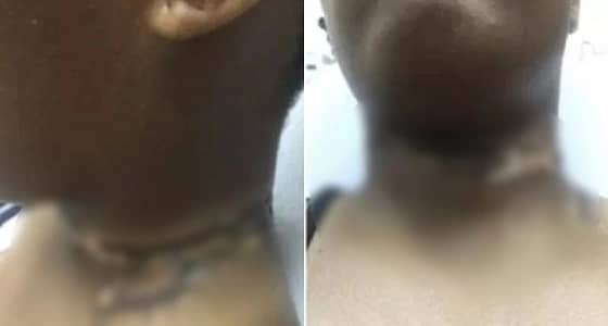 شاحن آيفون يحرق رقبة فتاه ويشوهها