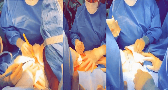 لأول مرة.. فيديو يوثق لحظة فصل التوأم السيامي الليبي «أحمد ومحمد» بالرياض