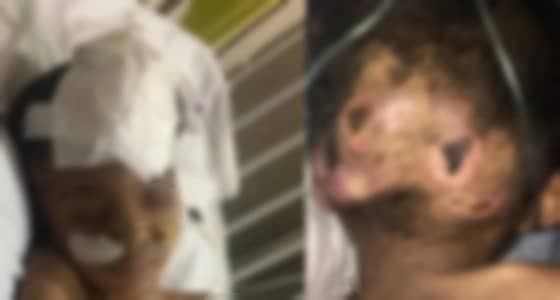 خميس مشيط.. إصابة طفل بالشلل بعد تعنيفه على يد زوج والدته