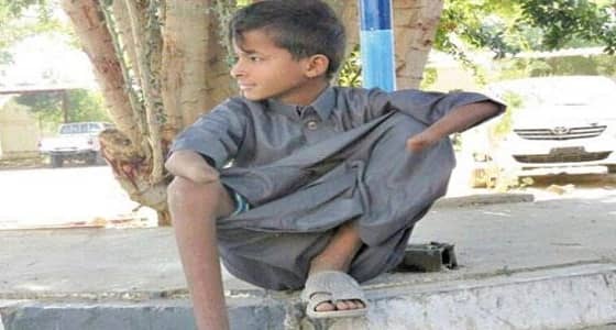 قصص مأسوية لليمنيين بسبب ألغام الحوثي