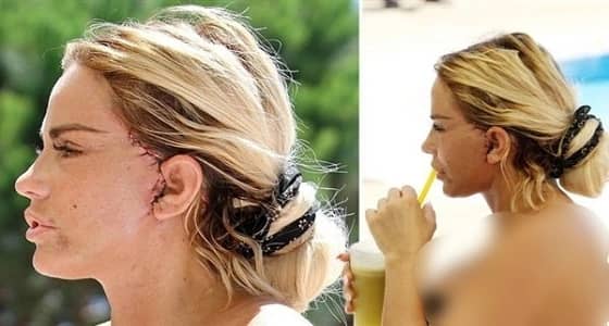 أطباء تركيا يشوهون جمال عارضة أزياء شهيرة