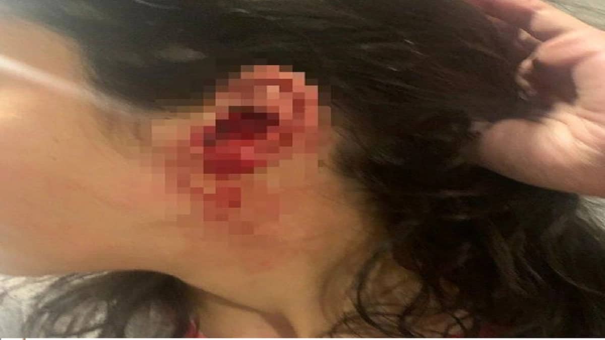 بالصورة..استغاثة فتاة عنفها شقيقها وقطع أذن أختها